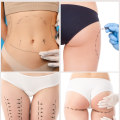 Liposuction for Different Areas of the Body