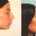 Rhinoplasty Before and After Photos: A Comprehensive Guide