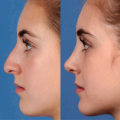 What is the medical term for plastic surgery of the face?