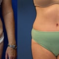 Tummy Tuck Before and After Photos: A Comprehensive Guide for Plastic Surgeons