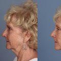 Understanding the Risks and Complications of Facelift Surgery