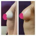 Breast Augmentation Before and After Photos: What You Need to Know