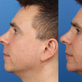 Before and After Photos: A Guide to Choosing a Qualified Plastic Surgeon