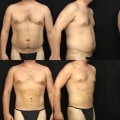 Different Techniques for Liposuction: A Comprehensive Overview