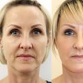 Showcasing the Transformation: The Power of Facelift Before and After Photos