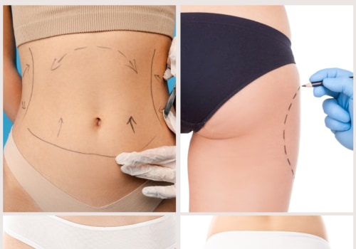 Liposuction for Different Areas of the Body