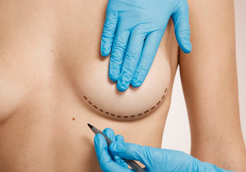 Breast Implant Placement Options for Your Ideal Cosmetic Surgery