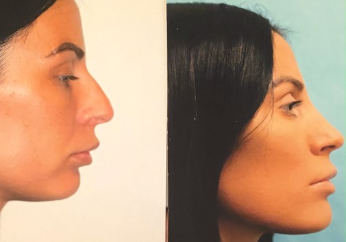 Rhinoplasty Before and After Photos: A Comprehensive Guide