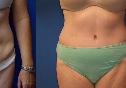 Tummy Tuck Before and After Photos: A Comprehensive Guide for Plastic Surgeons