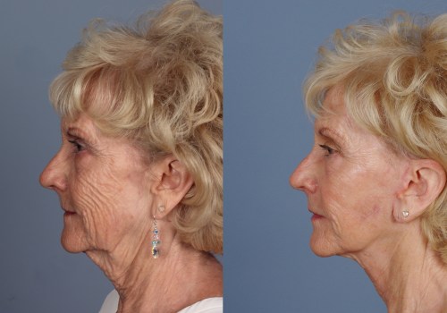 Understanding the Risks and Complications of Facelift Surgery