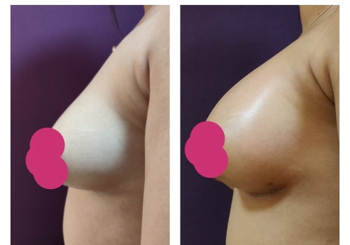 Breast Augmentation Before and After Photos: What You Need to Know