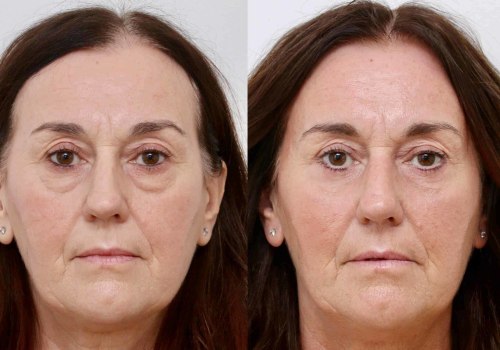 How Blepharoplasty Before and After Photos Can Help You Choose the Right Plastic Surgeon