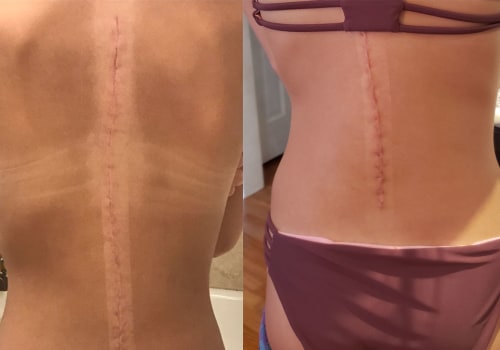 Tips for Minimizing Scarring After Surgery