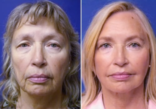 Traditional Facelift vs. Mini Facelift: Understanding the Differences and Choosing the Right Procedure