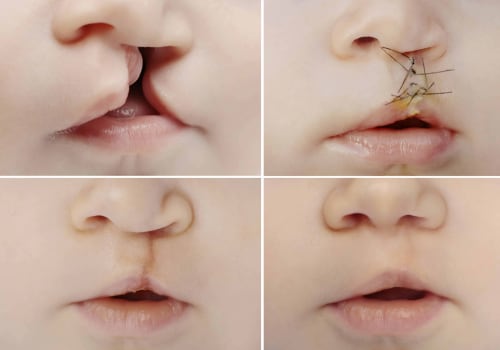 Stages of Cleft Lip and Palate Repair Surgery