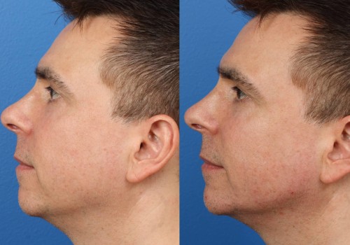 Before and After Photos: A Guide to Choosing a Qualified Plastic Surgeon