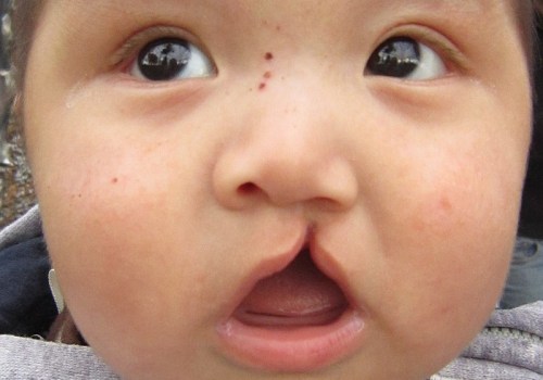 Understanding the Success Rate for Cleft Lip and Palate Repair