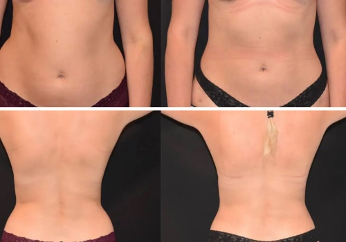 Liposuction Before and After Photos: What You Need to Know