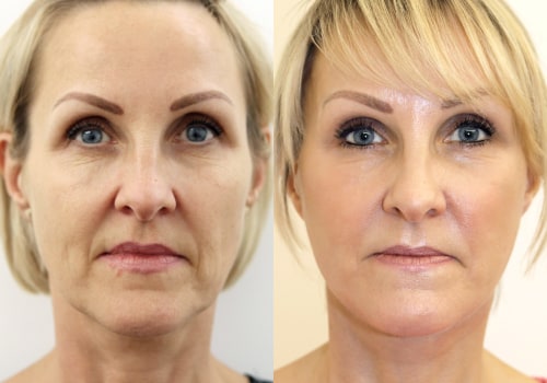 Showcasing the Transformation: The Power of Facelift Before and After Photos